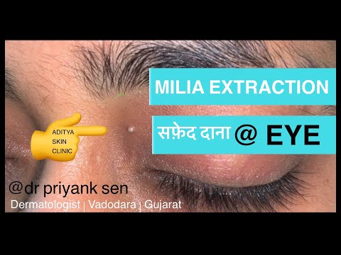 MILIA EXTRACTION | सफ़ेद फुंसी वाला दाना आँख के पास | इलाज FULL VIDEO by DERMATOLOGIST in HINDI 👁🖕