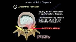 Sciatica, symptoms , diagnosis ,and treatment. conditions that mimic sciatica.