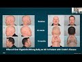 Alopecia Areata - Part Three: The Future