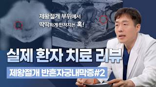 제왕절개 흉터가 아프다면? '반흔 자궁내막증' 실제 환자 사례