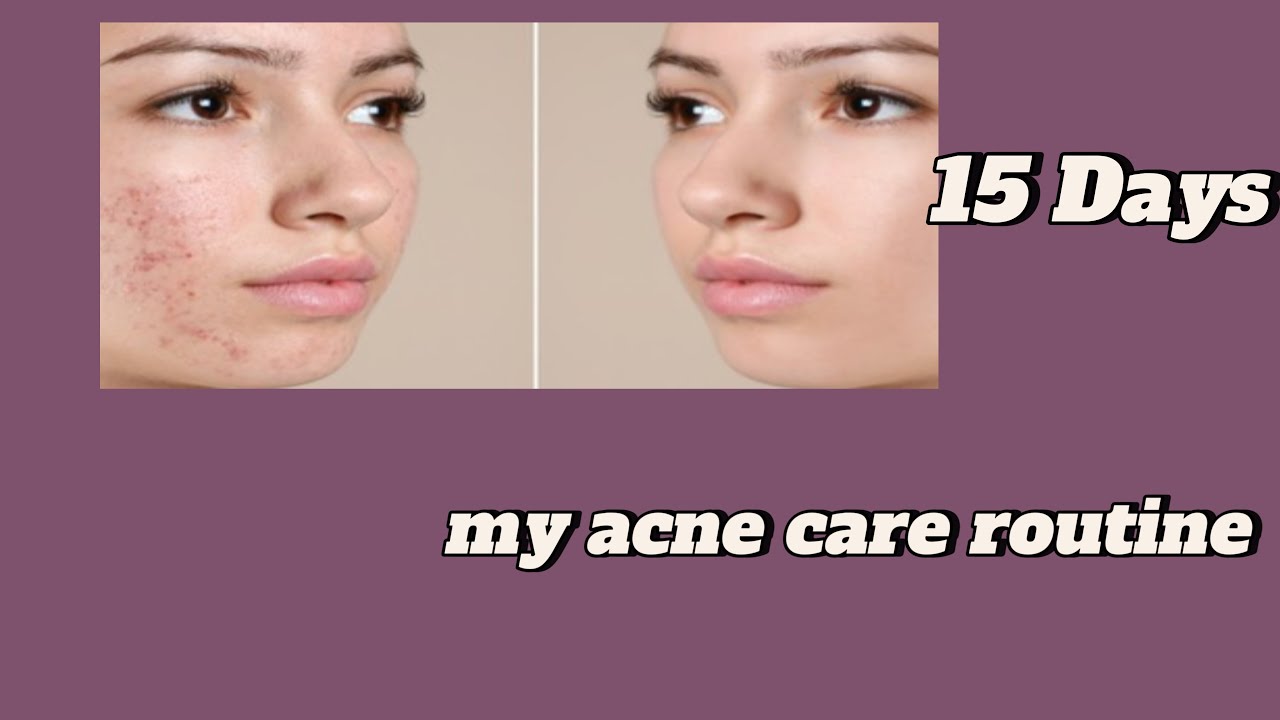 Meri acne journey | how I got rid of my acne | tips for clear skin ...