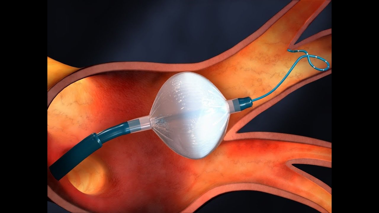Diagnoza i leczenie migotania przedsionków