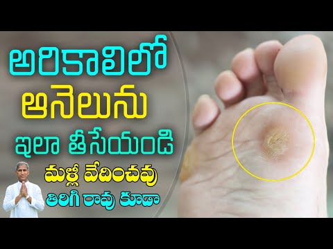 అరికాలి ఆనెలు ను ఇలా తొలగించండి | How to Removal Foot Corn ? | Dr Manthena Satyanarayana Raju Videos