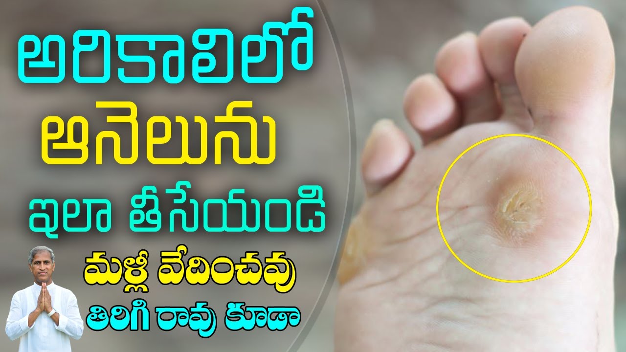అరికాలి ఆనెలు ను ఇలా తొలగించండి | How to Removal Foot Corn ? | Dr Manthena Satyanarayana Raju Videos