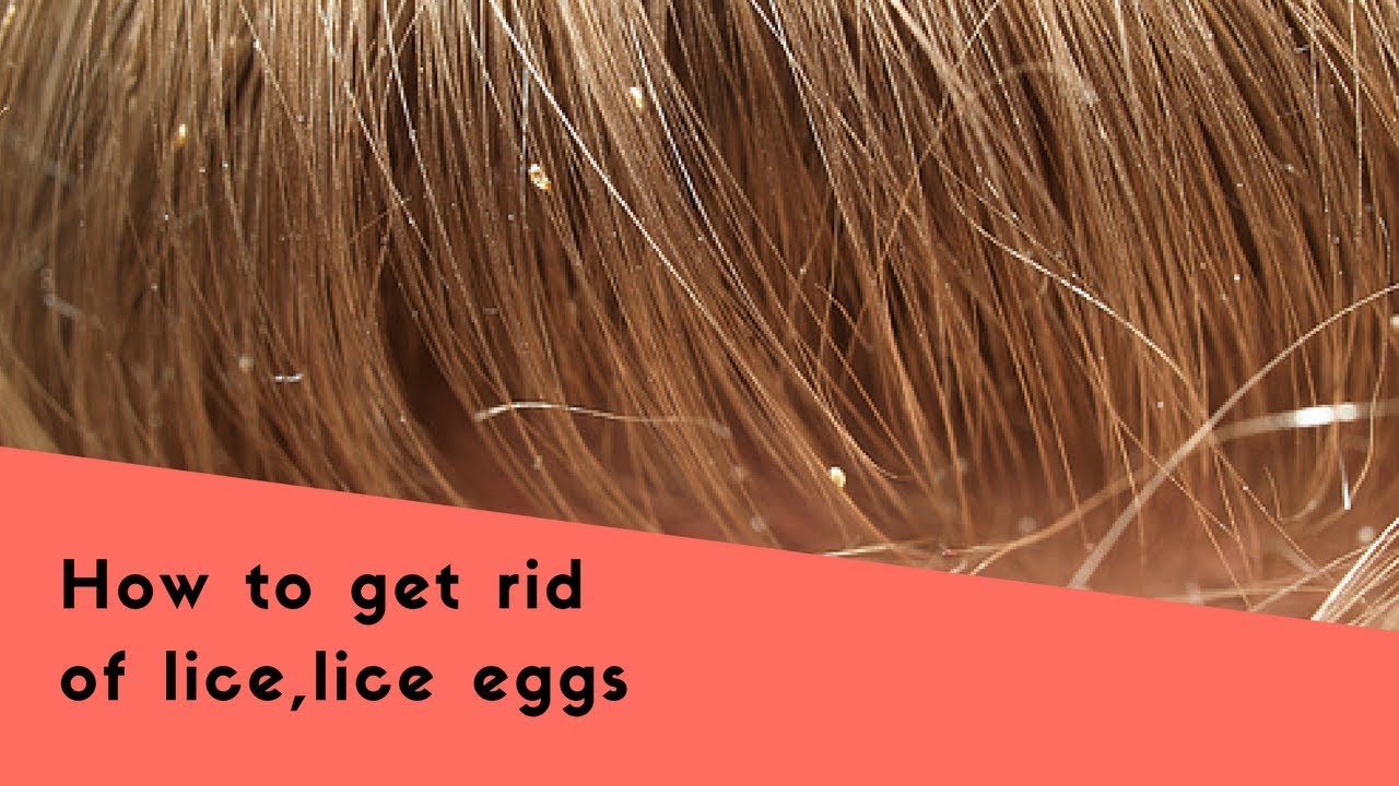 Tips To Get Rid Of Lice Eggs Lice Eggs Removal Home Remedies KRI