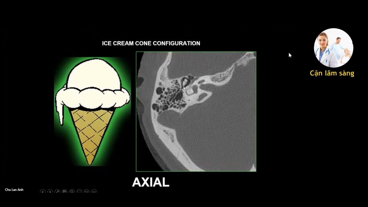 Hướng dẫn đọc phim CT Tai - xương đá