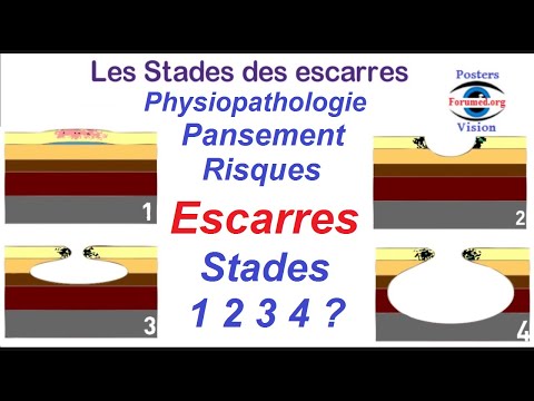 Vidéo: Les Escarres Chez Les Patients Alités - Risque Et Stades De Développement Des Escarres, Traitement Cutané. Comment Traiter Les Escarres?