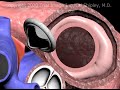 Mitral Valve Replacement Procedure Animation by Cal Shipley, M.D.