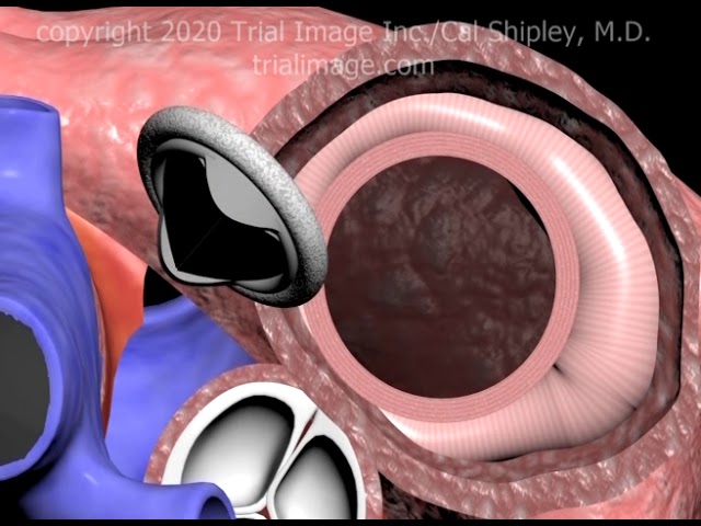 Mitral Valve Replacement Procedure Animation by Cal Shipley, M.D. class=