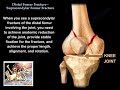 Distal Femur Supracondylar Fracture  - Everything You Need To Know - Dr. Nabil Ebraheim