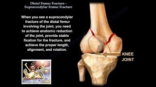 Distal Femur Supracondylar Fracture - Everything You Need To Know - Dr. Nabil Ebraheim