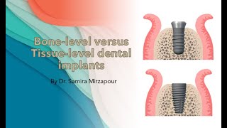 Bonelevel versus Tissuelevel Dental Implants