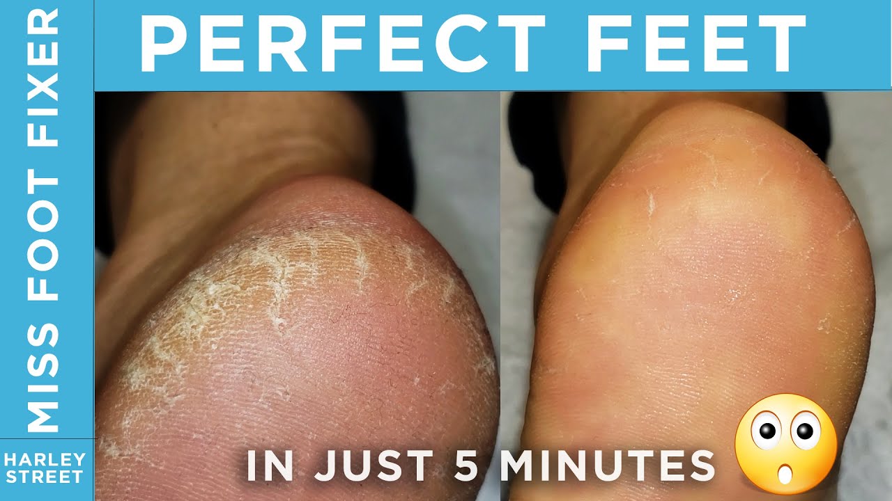 How May A Podiatrist Treat Cracked Heels | Midland Podiatry