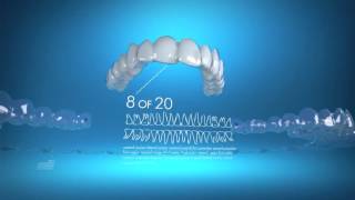 How Invisalign Works