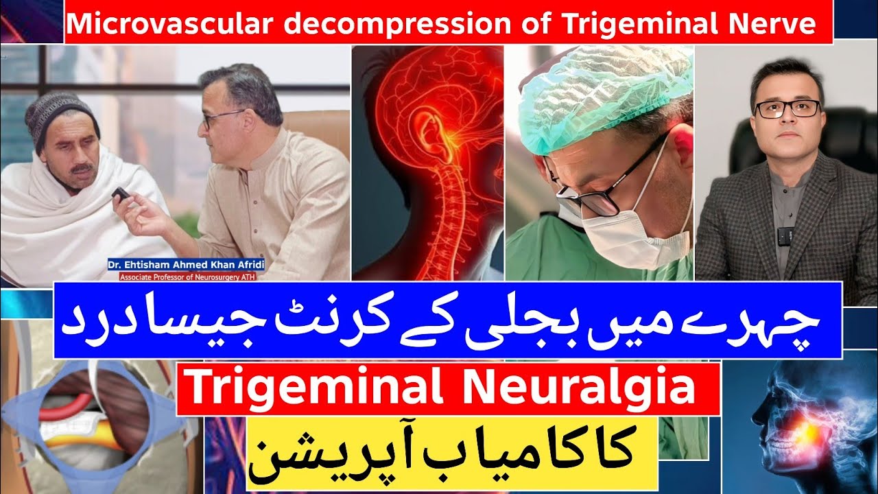 Trigeminal Neuralgia: Facial pain | Successfully Operated