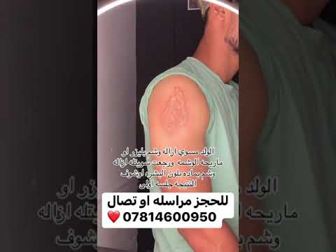 ازاله الوشم بحبر بلون جلد باعو نتيجه جلسه اوله