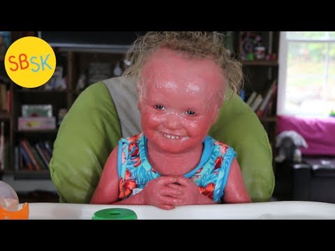 My Friend with Harlequin Ichthyosis (Skin that Grows Too Fast)
