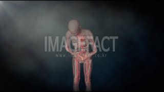 Chronic Pelycalgia Endometriosis