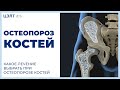 Остеопороз костей. 🌞 Какое лечение выбрать при остеопорозе костей. ЦЭЛТ