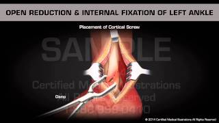 Open Reduction & Internal Fixation of Left Ankle