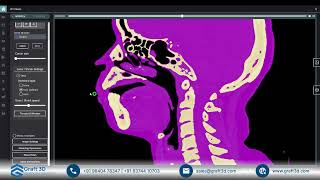 Advanced Airway & Skull Segmentation from CT Data | Elucis Next