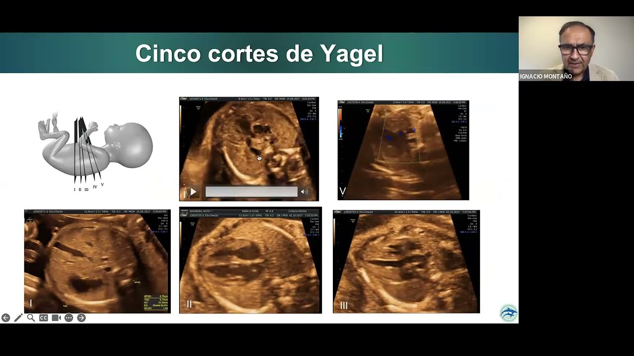 TAMIZAJE DE LAS CARDIOPATIAS CONGENITAS EN EL FETO
