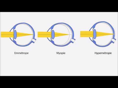 Vidéo: Amétropie: Symptômes, Traitement, Degrés, Types, Diagnostic