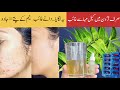 How to remove Pimples, Acne Marks| Neem Face Serum for acne & Clear Skin | Husnology