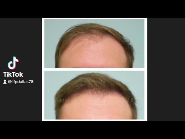 Dallas Male Hair Transplant Before and After