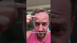 Hair transplant update day 14 (Casey Zander aesthetic glow up happening)