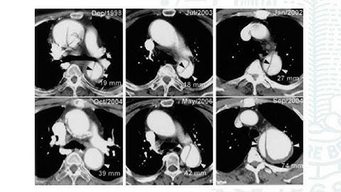 UCSF Vascular Surgery Symposium - What Determines Aortic False Lumen Growth Post Dissection?