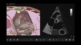 Basic Echocardiography: Using augmented reality to learn cardiac windows and views