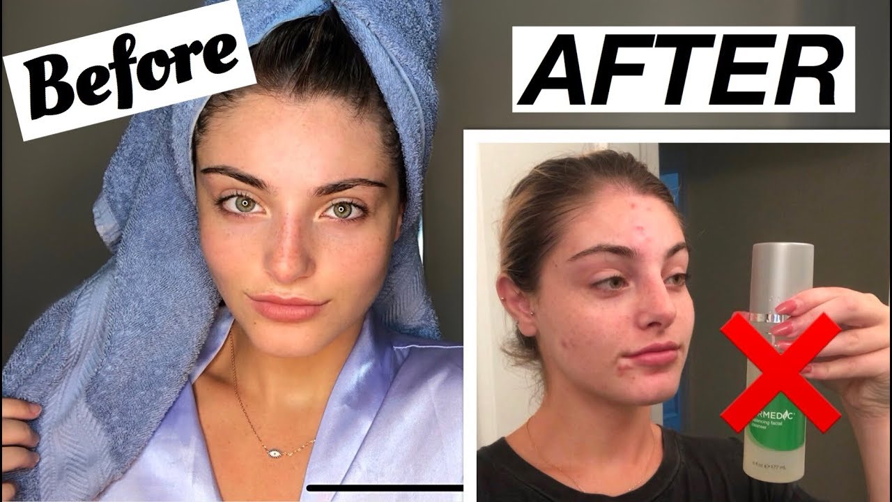 I Didn T Wash My Face For A Month Straight And This Is What Happened Acne Journey Youtube