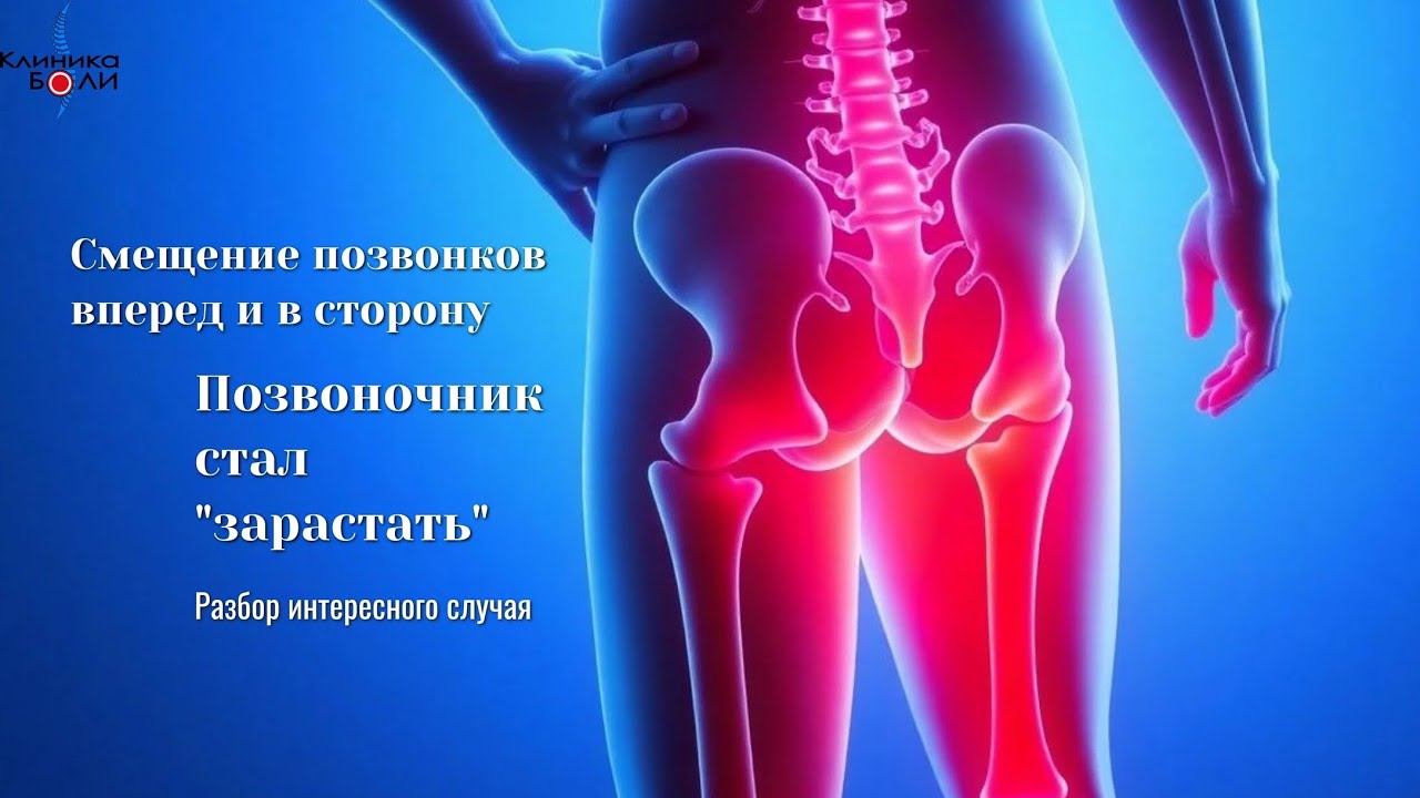 Смещение позвонков вперед и в сторону. Позвоночник стал «зарастать». Разбор интересного случая. 