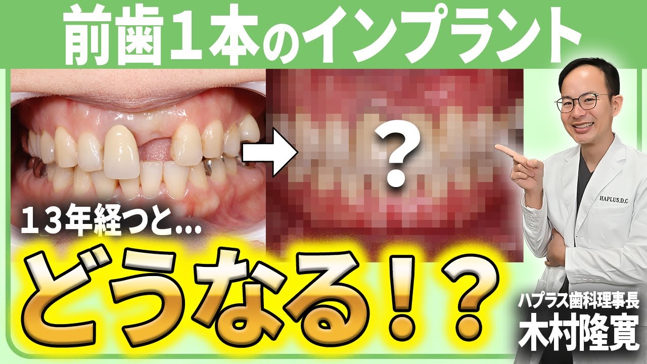 An implant specialist explains a case of long-lasting