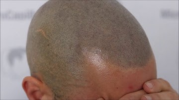 Hair transplant vs Scalp micropigmentation capillaire/ CLINIQUE MICROCAPILLAIRE