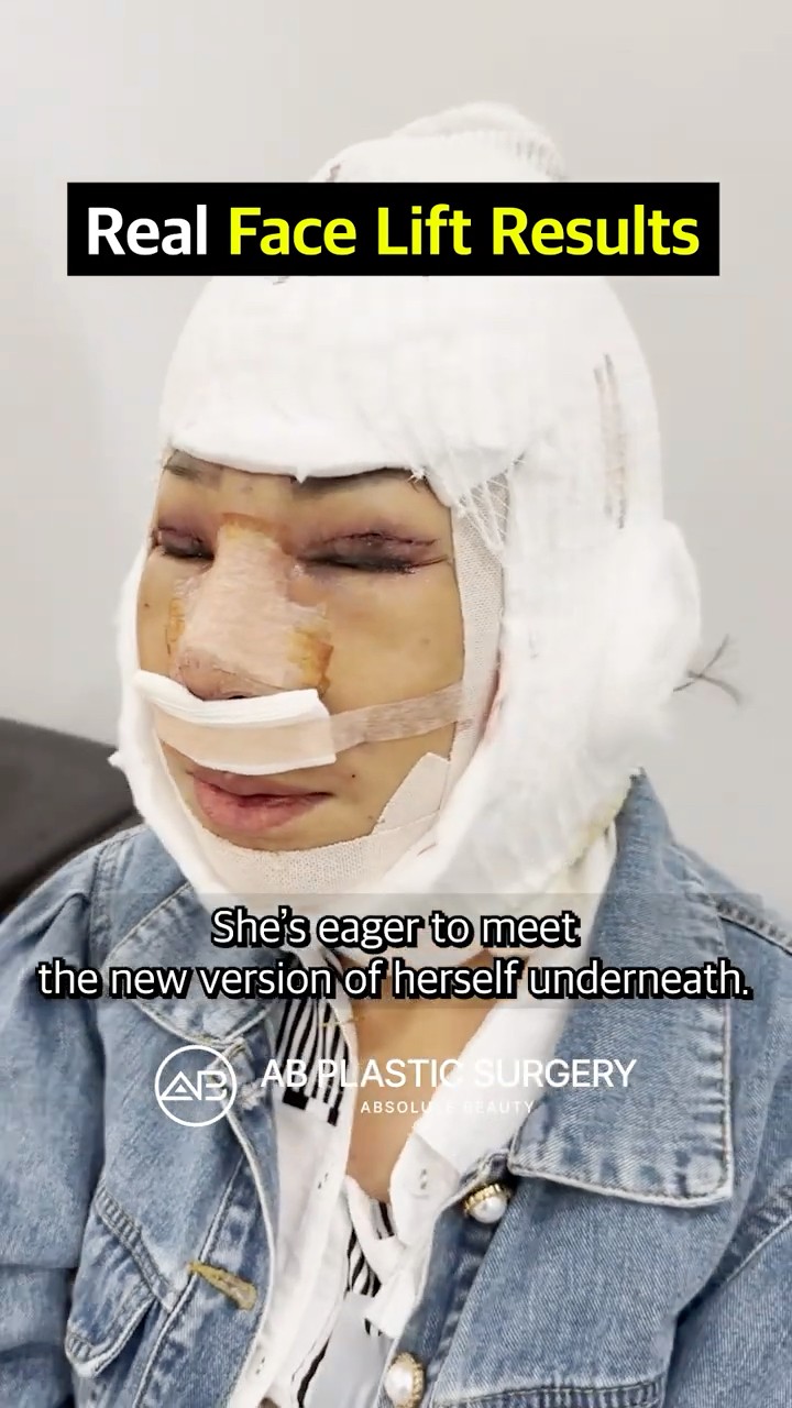 My Facelift in Korea: 2 Weeks Result #shorts