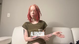 What is Albinism My experience tips advice