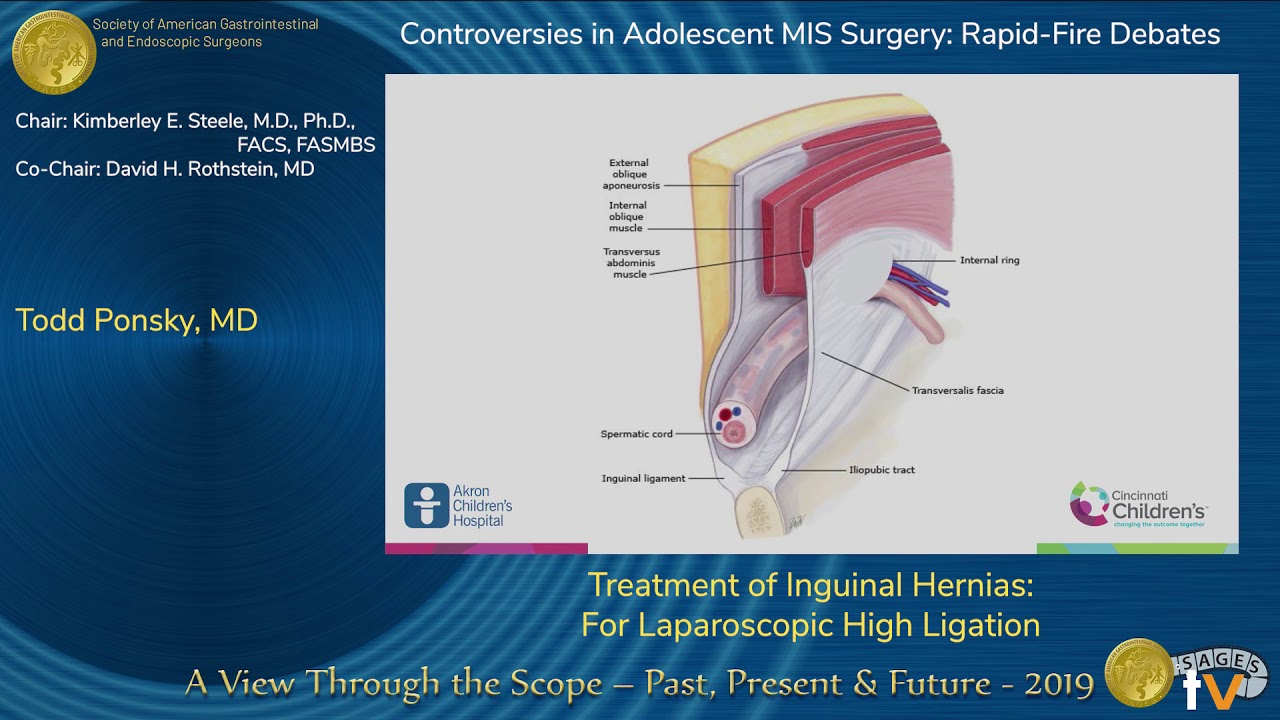 Icd 10 Code For Inguinal Hernias