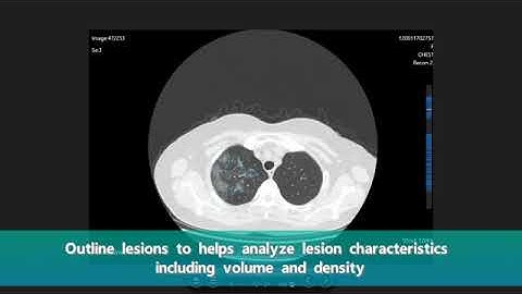 CT chest scans using AI based Machine Vision - for early detection of disease.