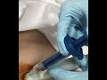 My Synvisc Injections BiKnee Joints Ultrasound Guided. Insurance Covers Every 6months, Lasts 3-4mos