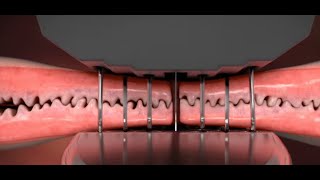 Medtronic TriStaple Wound Care - Ghost Medical Animation
Ghost Productions medical animation produced for Medtronic a medical device marketing piece that highlights the TriStaple product.
This visually compelling animation details the difference in increased tension between Tristaple Curved Tip pivoting anvil reloads and Competitors fixed anvil reloads.
The result of that design is a reload that provides superior strength and leak resistance across procedures.
Tri-Staple™ technology reloads are designed to work in harmony with the natural properties of tissue before, during, and after stapling. Each reload has a stepped cartridge face that delivers graduated compression and three rows of varied height staples. The Tri-Staple offers less stress via The Tri-Staple™ reload has a stepped cartridge face that delivers graduated compression and three rows of varied height staples. That design helps generate less stress on tissue during compression and clamping.
Ghost Medical has been producing award-winning medical animations and successful scientific visualizations for the medical and healthcare companies since 1994. We are committed to explaining medicine and its benefit to humanity by improving healthcare
outcomes with simulation-based training and medication visualization.
Learn how Ghost Productions Medical Animation Studio & Surgical VR Developer can help you explain how your medical devices and pharmaceutical products work.
Medical Animation: https://ghostproductions.com/animation/
Virtual Reality: https://ghostproductions.com/medical-vr-virtual-reality/
(651) 633-1163
#ghostproductions
#ghostmedical
#medicalanimation
#medicalmarketing Medtronic TriStaple Wound Care - Ghost Medical Animation