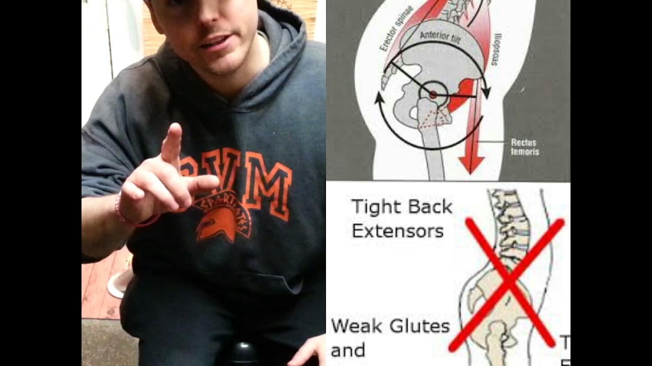 How To Fix Anterior Pelvic Tilt : NEVER SEEN SOLUTIONS - Stretches & Exercises (Part 1) exercise 14.1 class 11