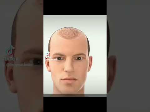 كيف يتم زراعة الشعر  #foryourbrain