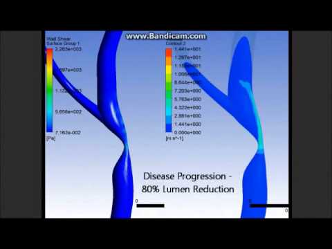 CFD Animation of Blood Flow Through a Model of a Left Coronary Artery