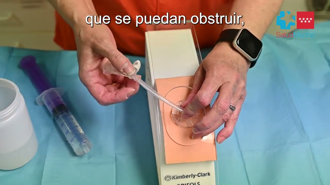 Hospital Gregorio Marañón - Gastrostomía Endoscópica Percutánea. Cuidados diarios de la sonda