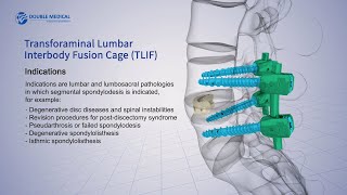 Double Medical Transforaminal Lumbar Interbody Fusion Cage (TLIF)