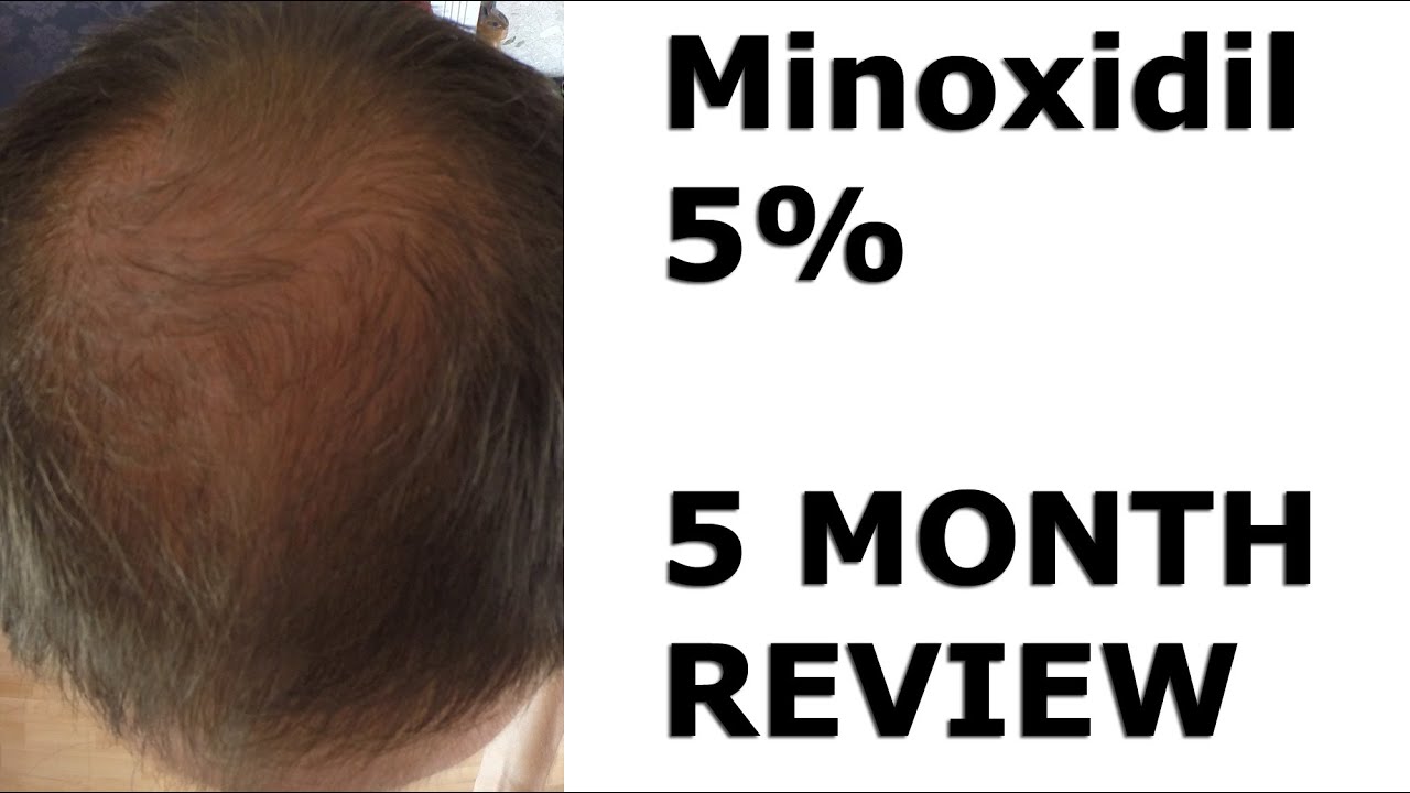 rogaine 5 minoxidil foam for hair regrowth