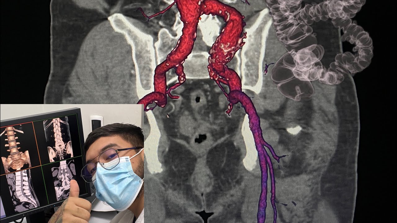 Clase 2 Factor PITCH en Tomografía Computarizada