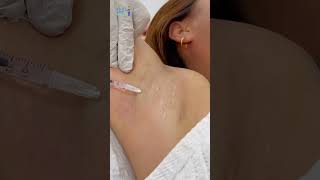 Botox For Underarm Sweating